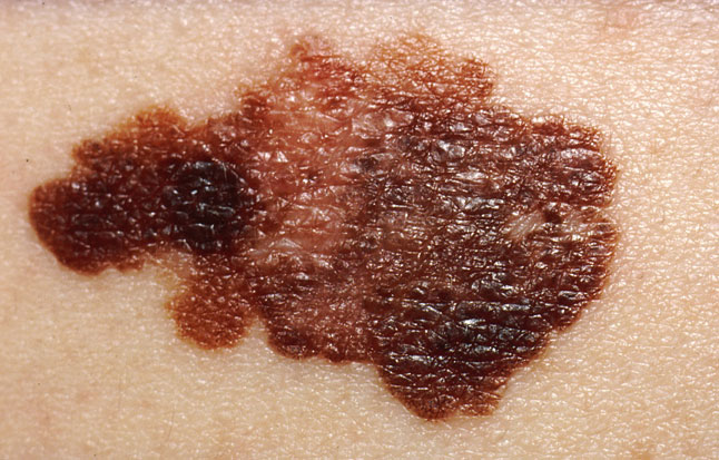 MELANOMA &ndash; NAP