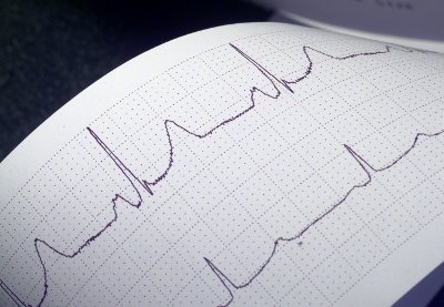 Eredmény ekg